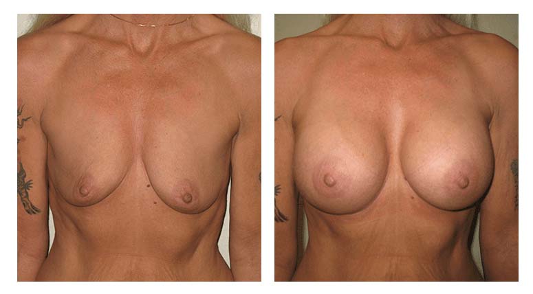 Breast Augmentation Patient 2 facing forward