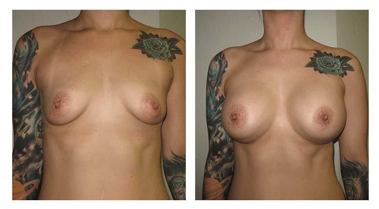 Breast Augmentation Patient 1 facing forward