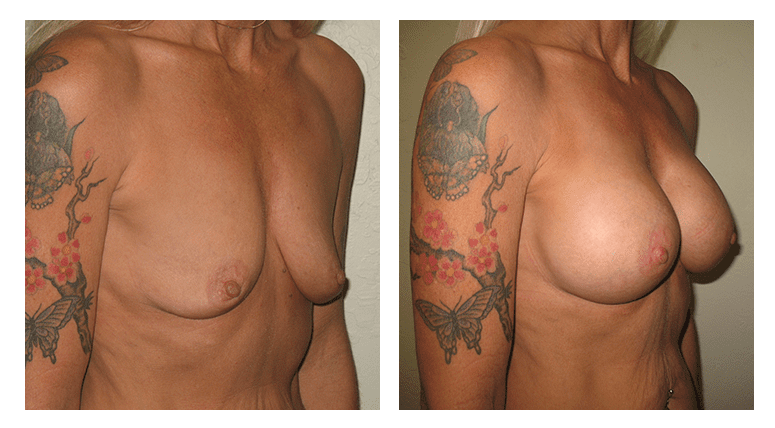 Breast Augmentation Patient 2 profile