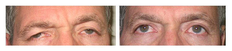 Blepharoplasty Patient 1