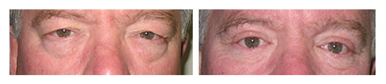 Blepharoplasty patient 2