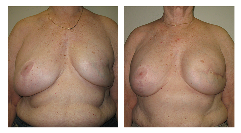 Breast Restoration patient 01