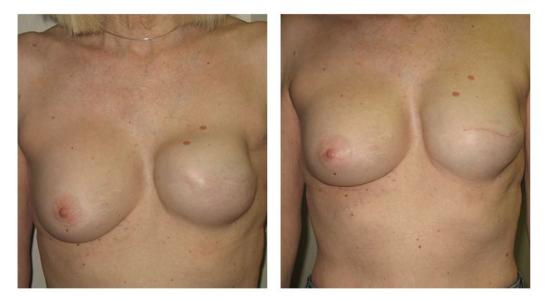 Breast Restoration patient 02