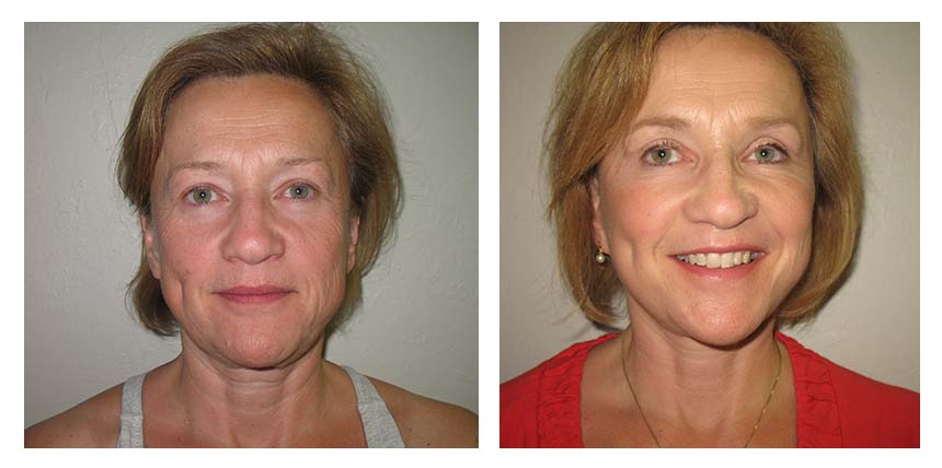 Face lift patient 01