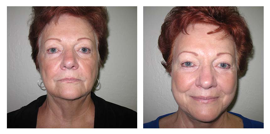 Face lift patient 02