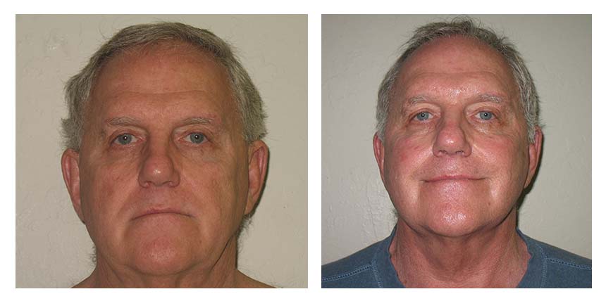 Face lift patient 03