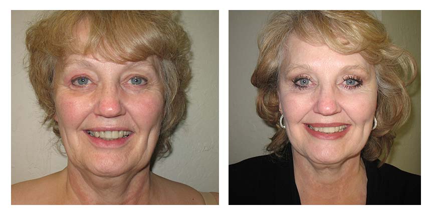 Face lift patient 04