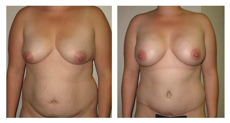 Mommy Makeover Patient 02