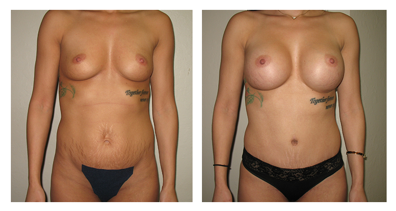 Mommy Makeover Patient 03