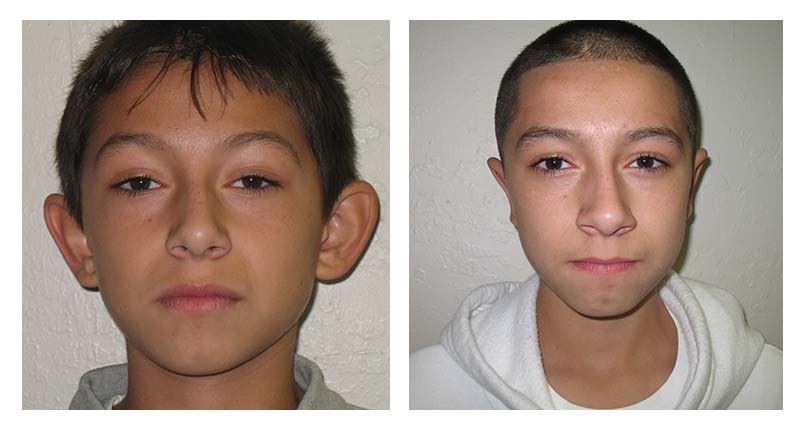 Otoplasty patient front view