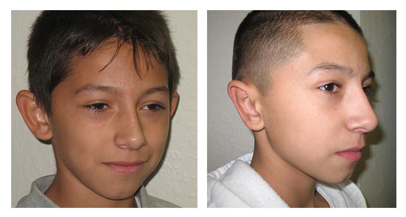 Otoplasty patient side view