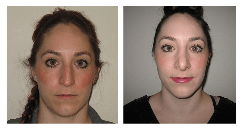 Rhinoplasty patient 1 front view