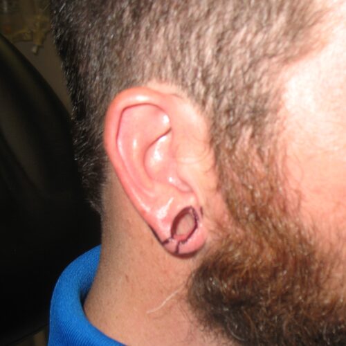 H earlobe before