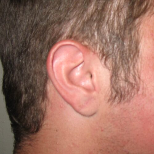 earlobe (after)