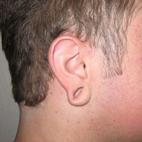 earlobe (before)