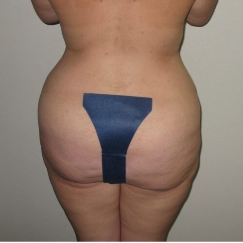 Case--1377 | After BBL Brazilian Buttock Lift
