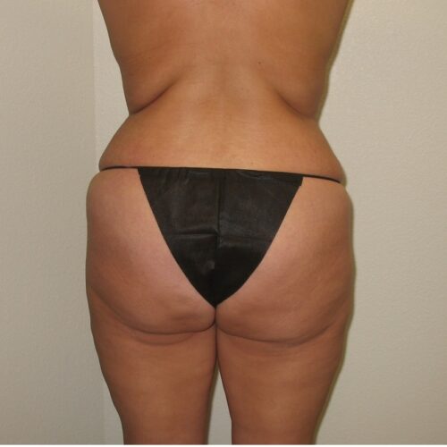 Case--1377 | Before BBL Brazilian Buttock Lift