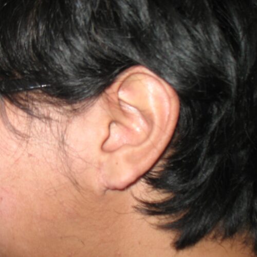 earlobe repair (before)