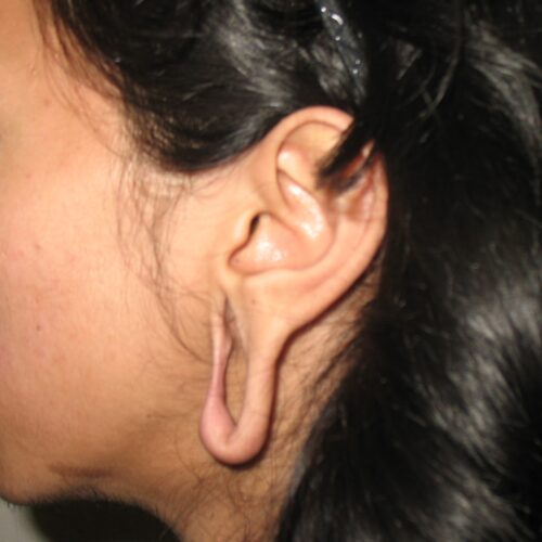 earlobe repair (before)