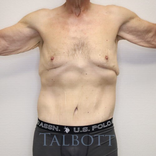 Case--5937 | Before Brachioplasty (arm lift)