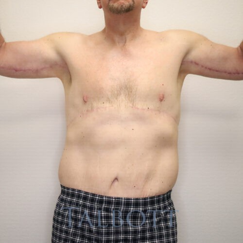 Case--5937 | After Brachioplasty (arm lift)