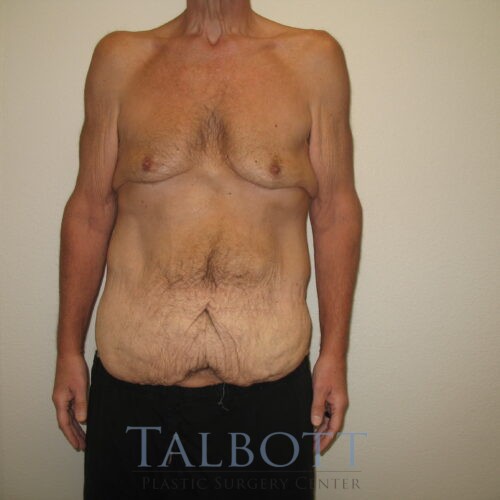 Case--7570 | Before Breast