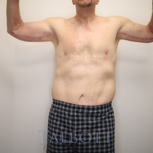 Case--7570 | After Breast